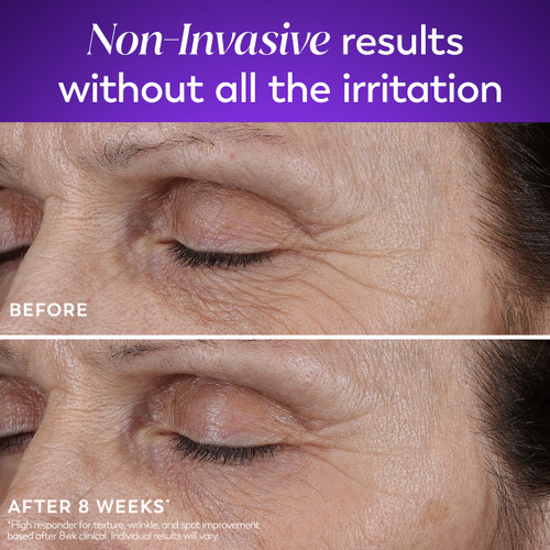 Model showing before and after using Retinol Max Face Moisturizer after 8 weeks*. Non-invasive results without all the irritation. *High responder for texture, wrinkle, and spot improvement based after 8week clinical. Individual results may vary.