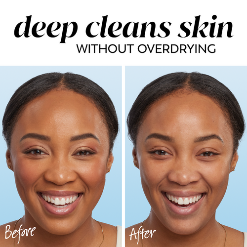 2 images model showing before and after. Deep cleans skin without over drying.